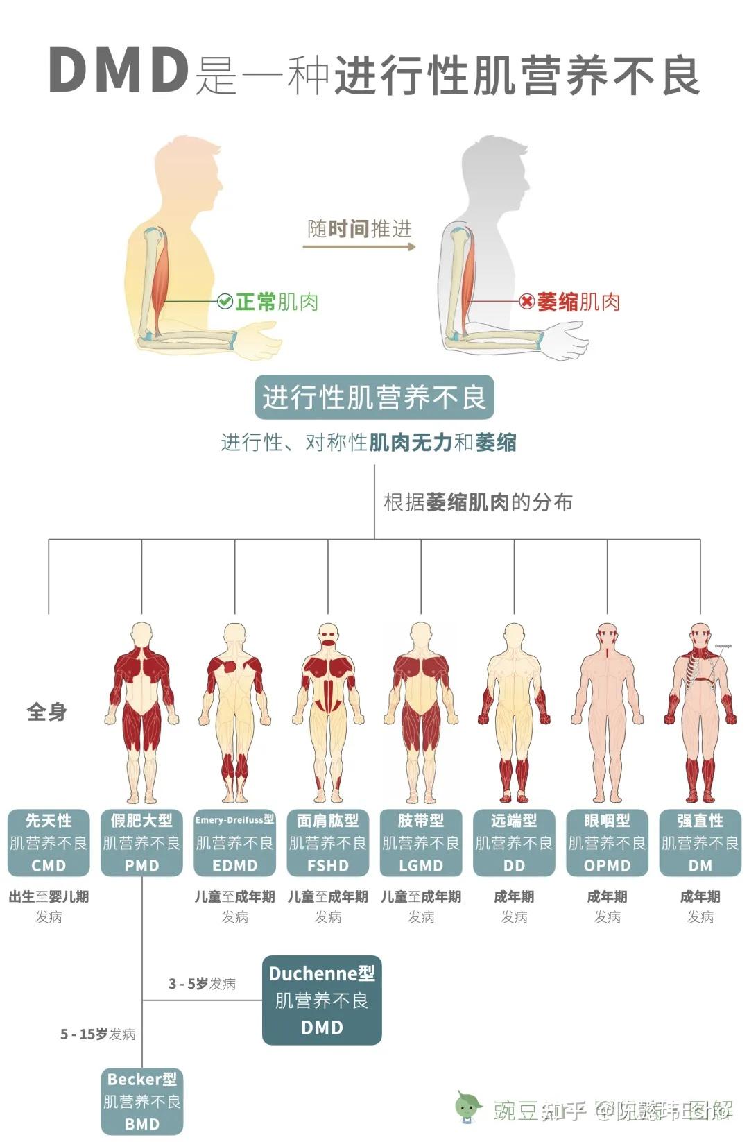 肌营养不良最新药物研究动态与未来展望